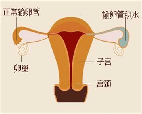 第三代试管婴儿技术可以排除哪些遗传病